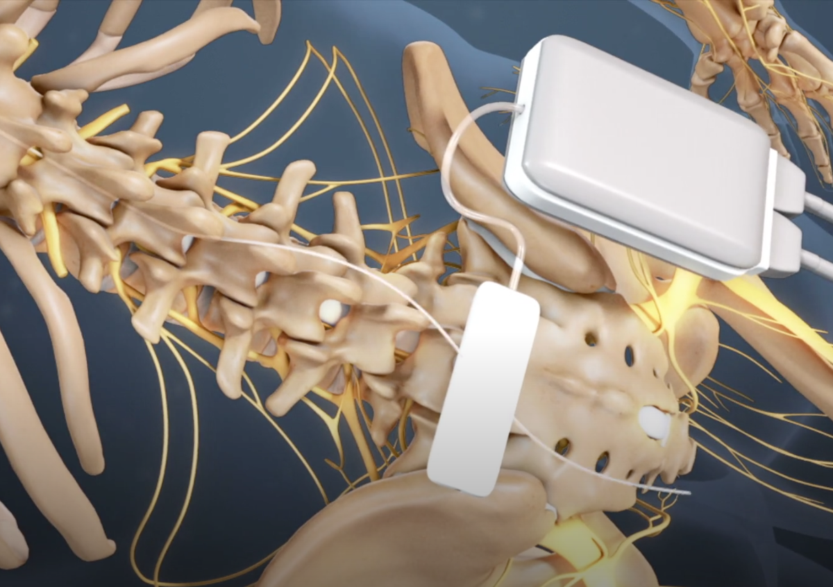 implantation abbott spinal cord stimulator